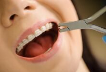 ceramic teeth braces