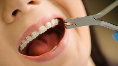 ceramic teeth braces