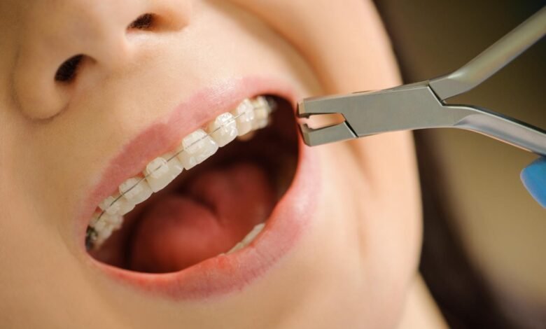ceramic teeth braces